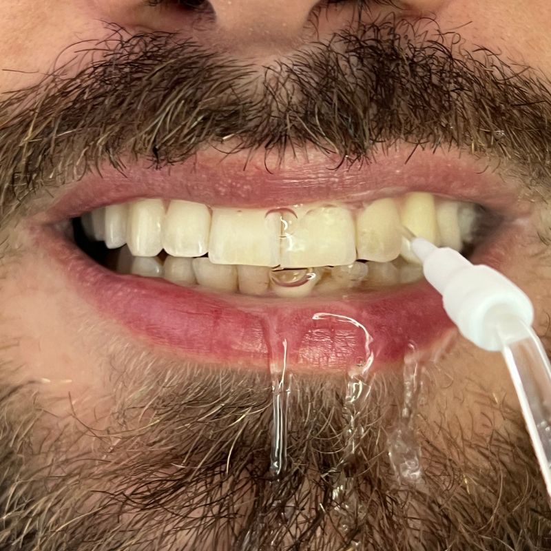 Irrigador-Oral-Limpeza-Profunda-Jato-D_agua-Supersonico_dente