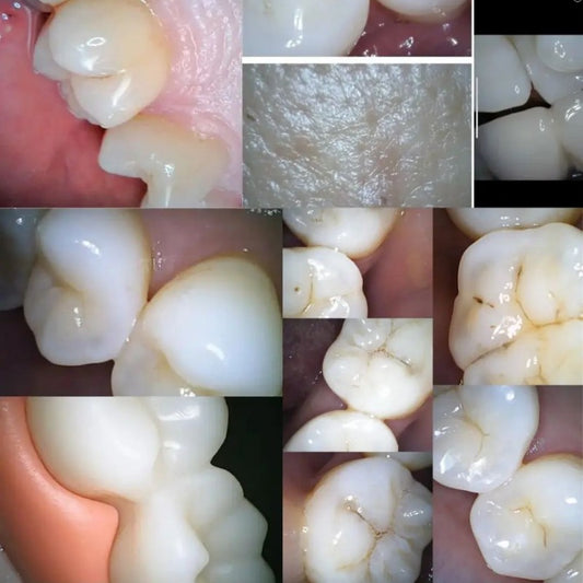 Câmera Intraoral Odontológica Sem Fio ViewPro
